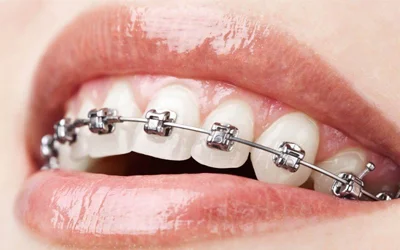 Orthodontics & Braces